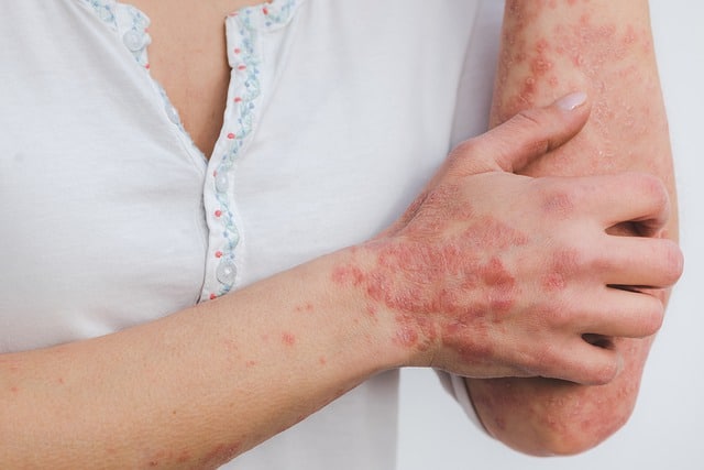 Psoriasis Diet Plan for Glowing Skin (Printable)