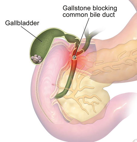 8 Foods That are Bad for Gallbladder