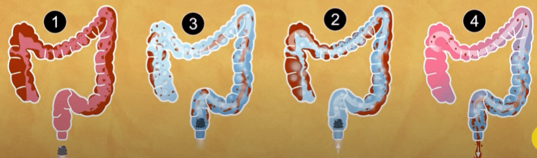 30 Day Water Fast 30 Day Water Fast