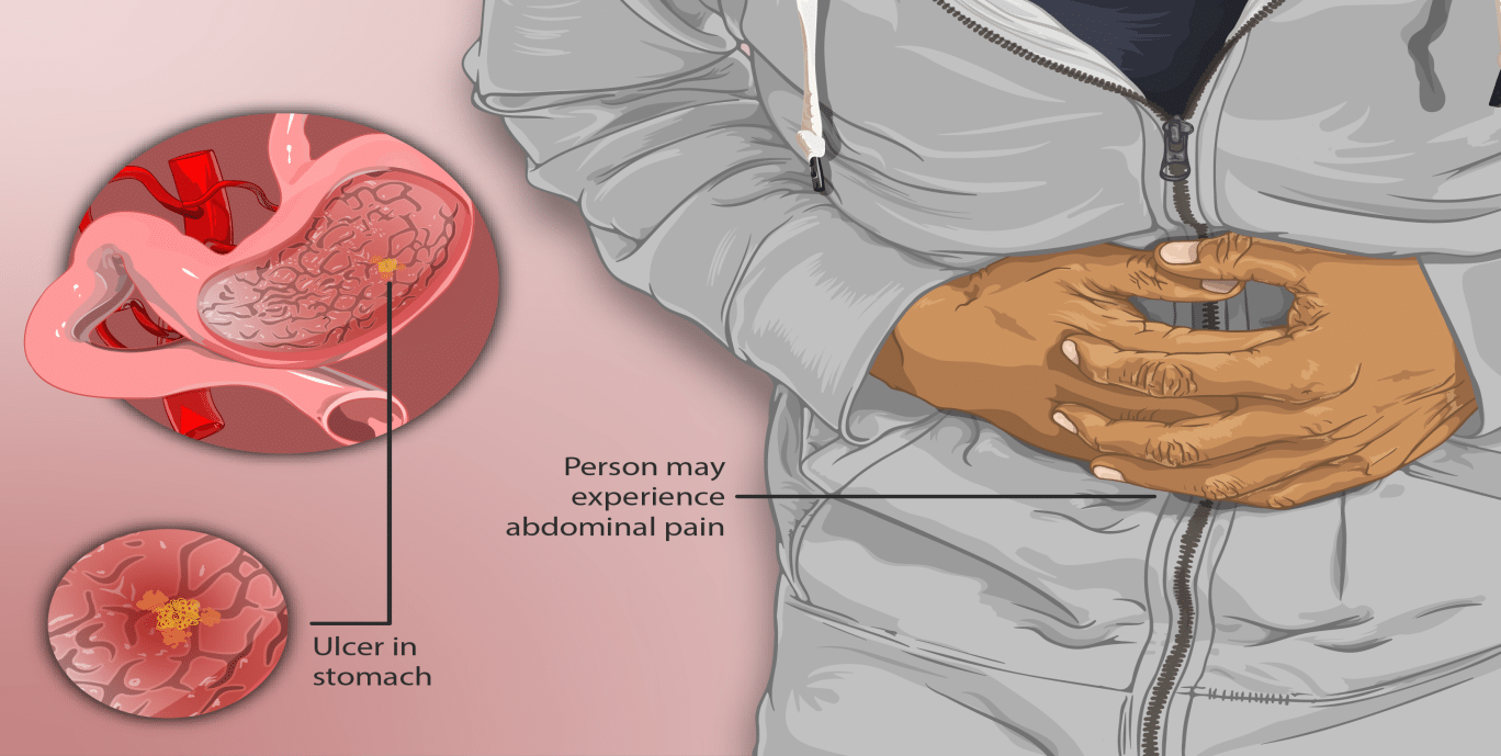 Printable Ulcer Diet Food List – Protect Your Stomach