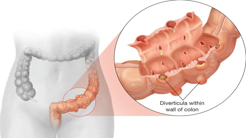 Diverticulitis Diet Plan Diverticulitis Diet Plan