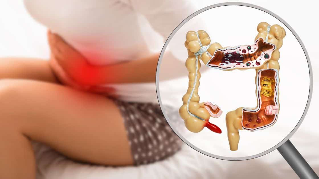 What is Diverticulitis?